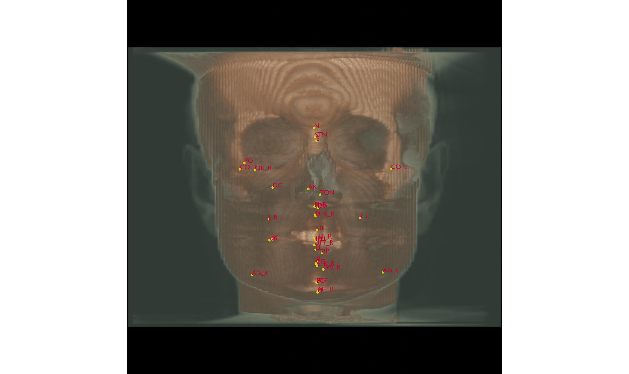 A CT skull rendered from the front with predicted and ground-truth landmark points overlaid.