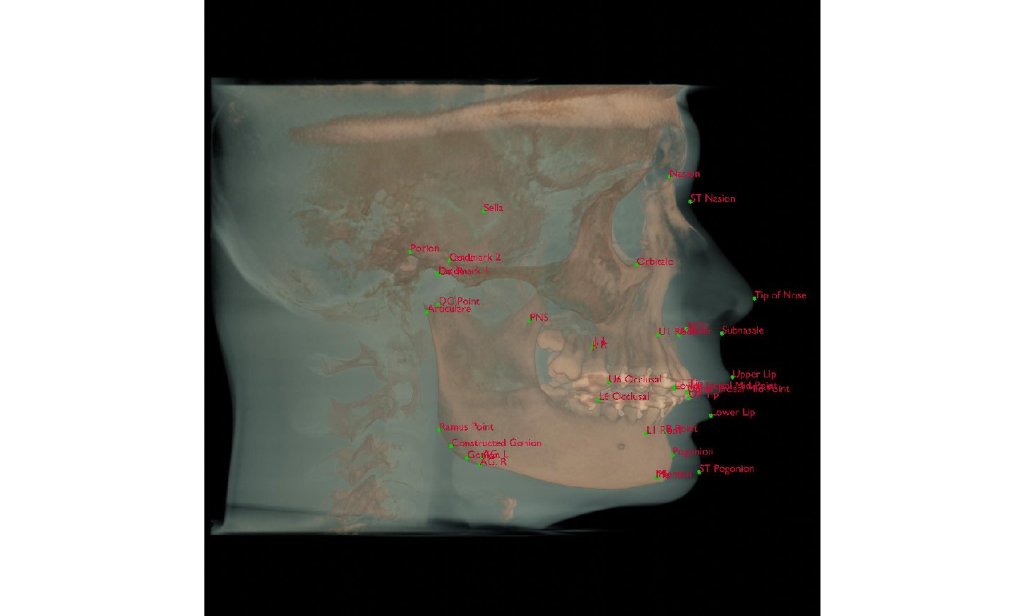 A CT skull rendered in profile with the doctor's cephalometric landmarks marked and labeled.